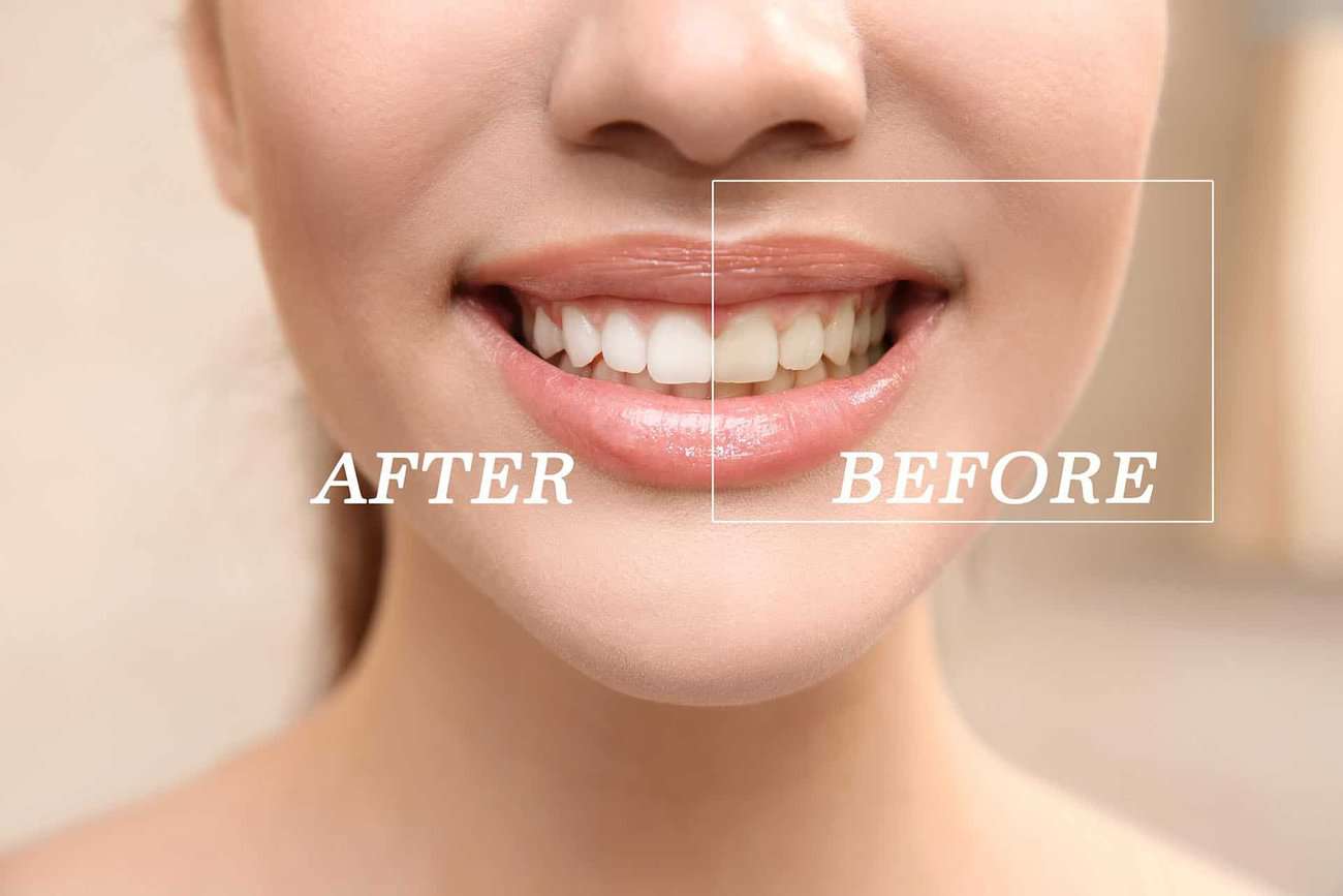 What Are the Most Effective Natural Teeth Whitening Methods You Can Try Harrogate?