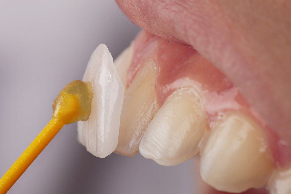 Dental Veneers: Achieving a Flawless Look Harrogate