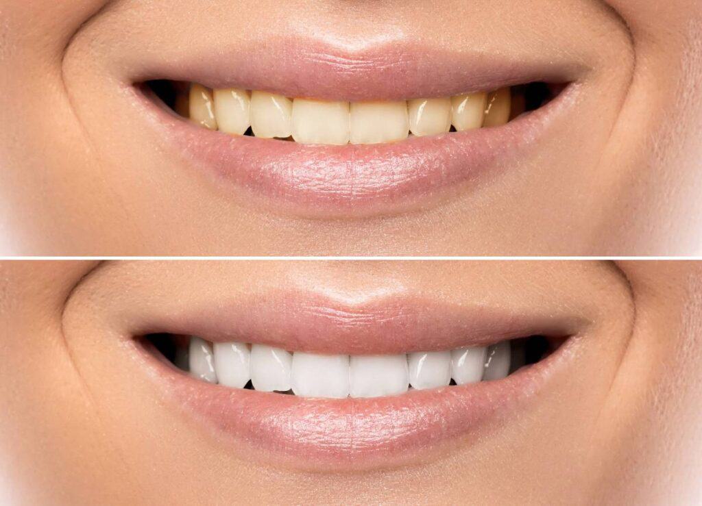 How Does Gum Disease Progress if Left Untreated Harrogate?