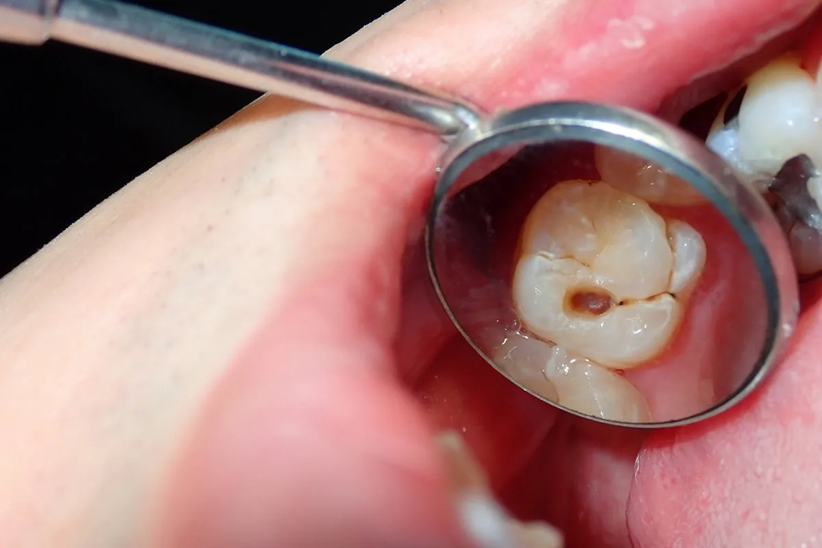 Why Do Teeth Crack? Common Causes to Know Harrogate