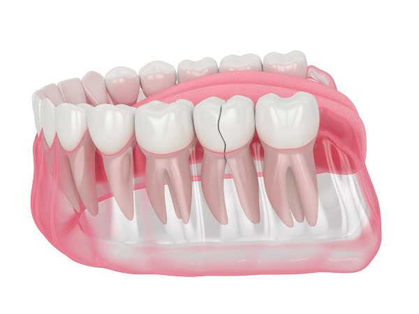 How Can You Manage Pain and Discomfort After a Root Canal Harrogate?