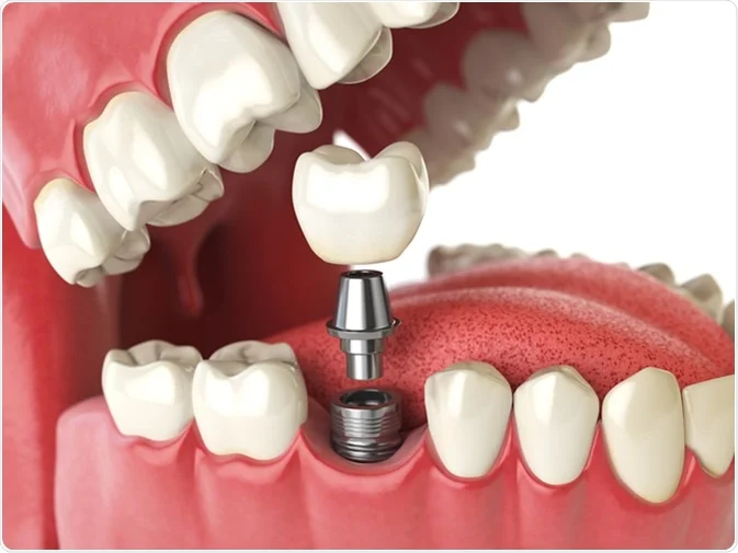 How Do I Decide Which Tooth Replacement Is Right for Me Harrogate?