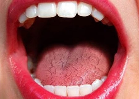 Dry Mouth and Its Role in Tooth Decay Harrogate
