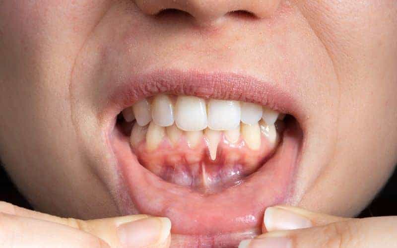 How Can Gum Disease Be Prevented Harrogate?