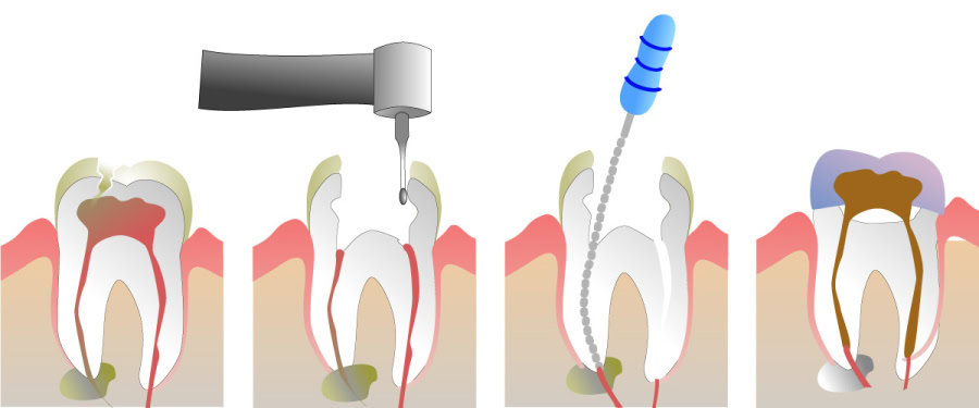 How Do You Properly Care for Your Teeth After a Root Canal Harrogate