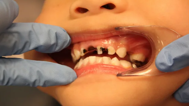 Which Foods and Drinks Cause the Most Damage to Young Smiles Harrogate?