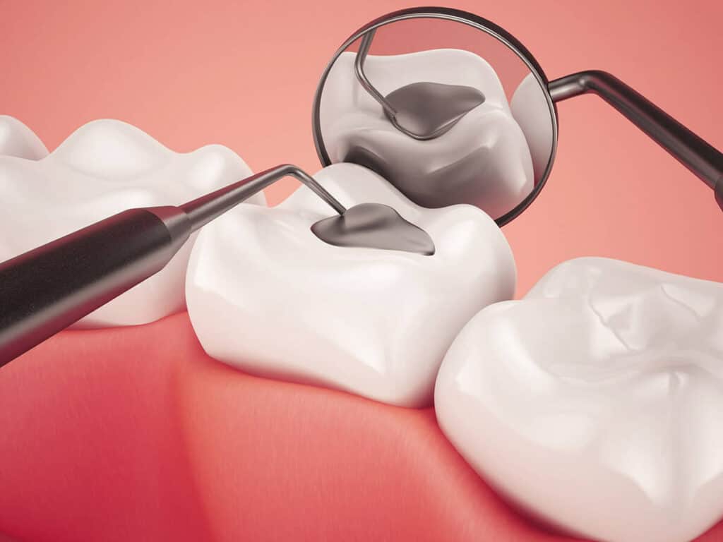 Fighting Cavities and Plaque Buildup Harrogate