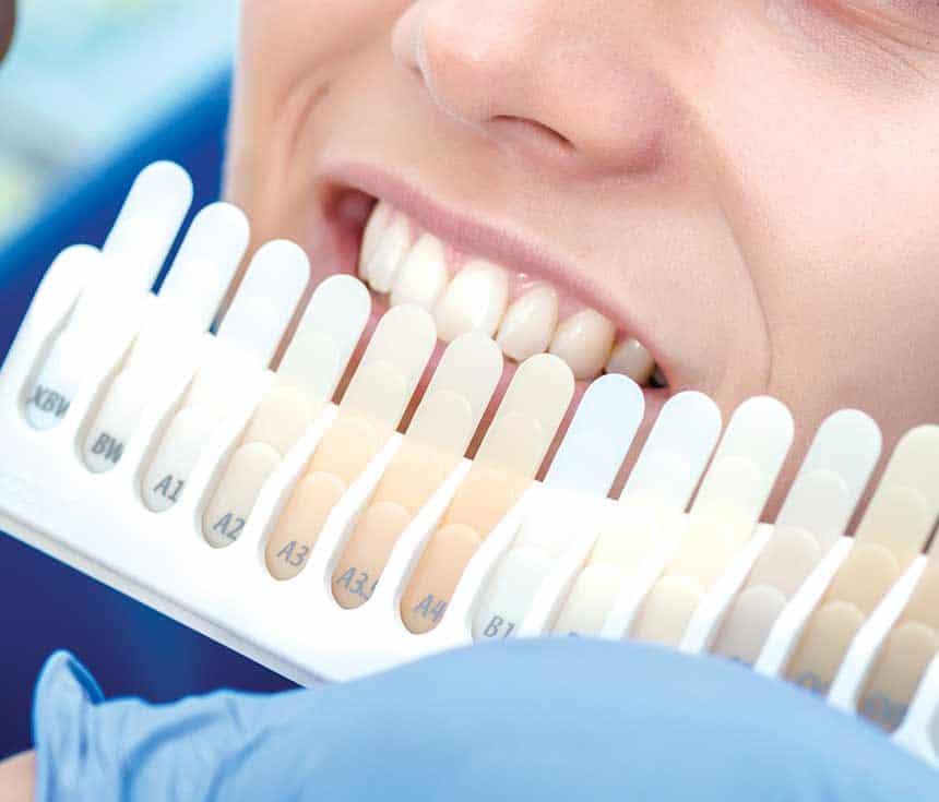 Professional vs At-Home Whitening: What You Need to Know Harrogate