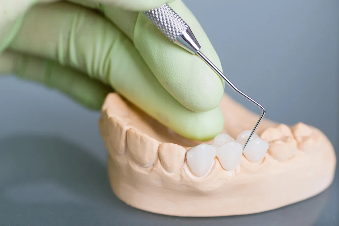 What Are the Different Types of Dental Crowns Available Harrogate?