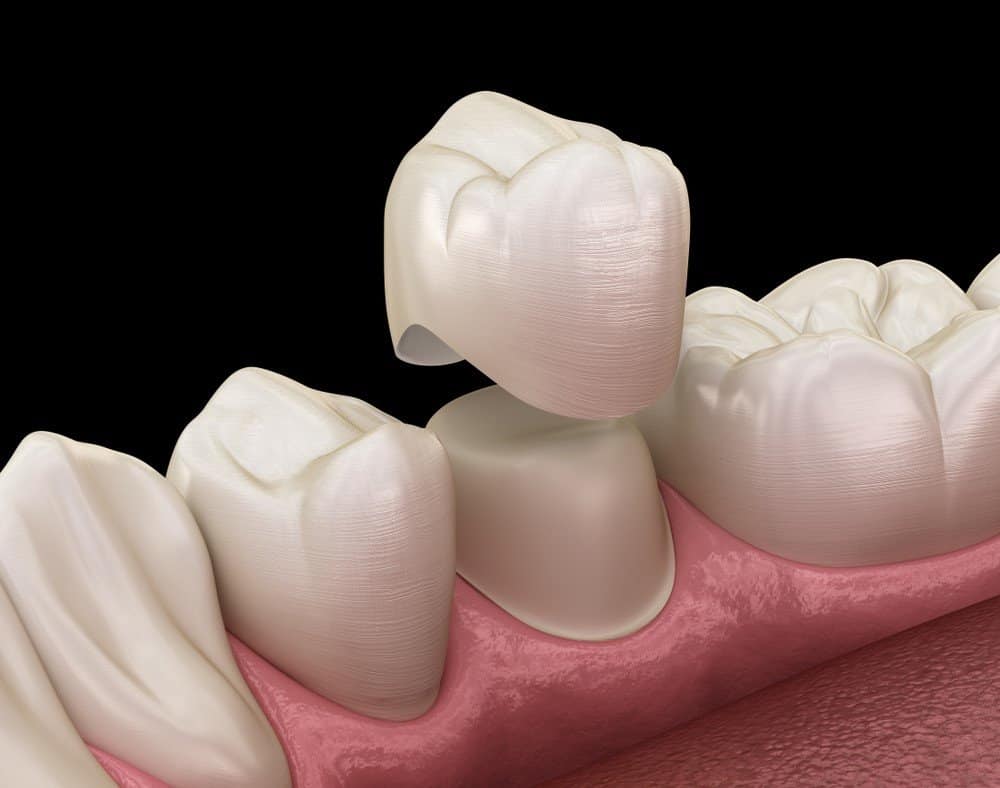 What Daily Habits Help Protect Your Dental Crowns Harrogate?