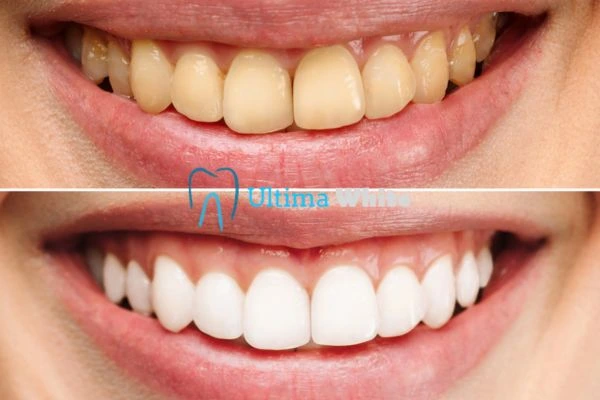 Why Might Multiple Whitening Sessions Be Necessary Harrogate?