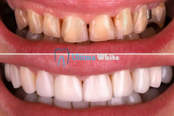 What Makes Instant Teeth Whitening Treatments So Popular Harrogate?