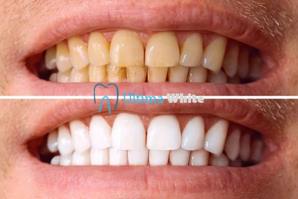 Stained Teeth and Persistent Bad Breath Harrogate