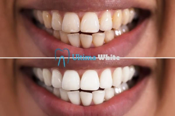 Aftercare Tips to Maintain Your New Smile Harrogate
